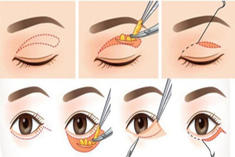 5 địa chỉ lấy mỡ bọng mắt chất lượng và uy tín hàng đầu tại Đà Nẵng