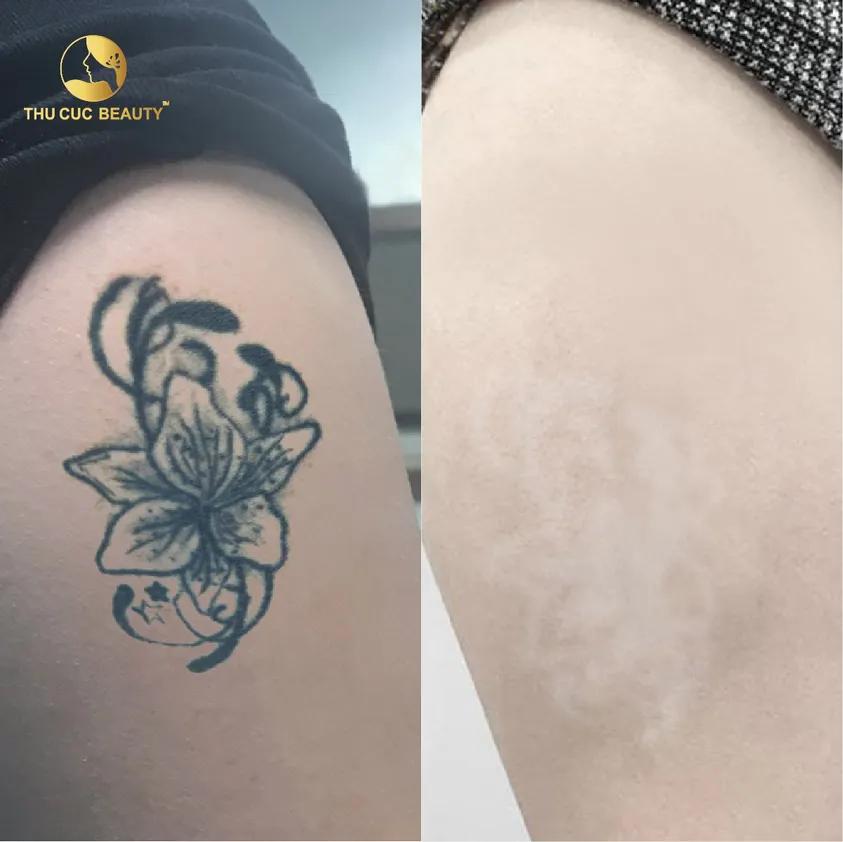 10 địa chỉ xóa xăm không để sẹo uy tín nhất TP.HCM