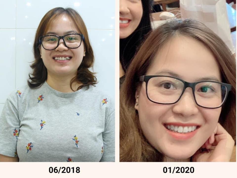 6 Địa Chỉ Niềng Răng Uy Tín & Chất Lượng Hàng Đầu Tại Đà Lạt