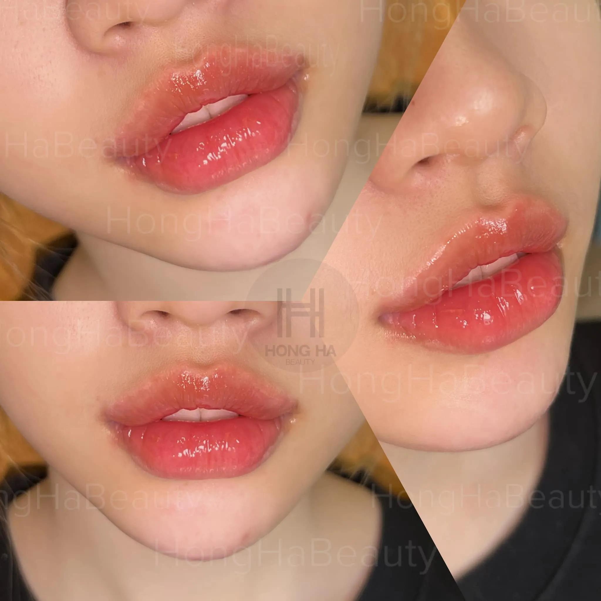 8 địa chỉ tiêm filler - botox đáng tin cậy và chất lượng hàng đầu tại Ninh Thuận