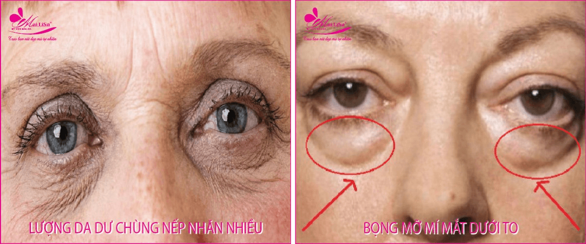 Top 8 địa chỉ lấy mỡ bọng mắt chất lượng và uy tín bậc nhất Cần Thơ