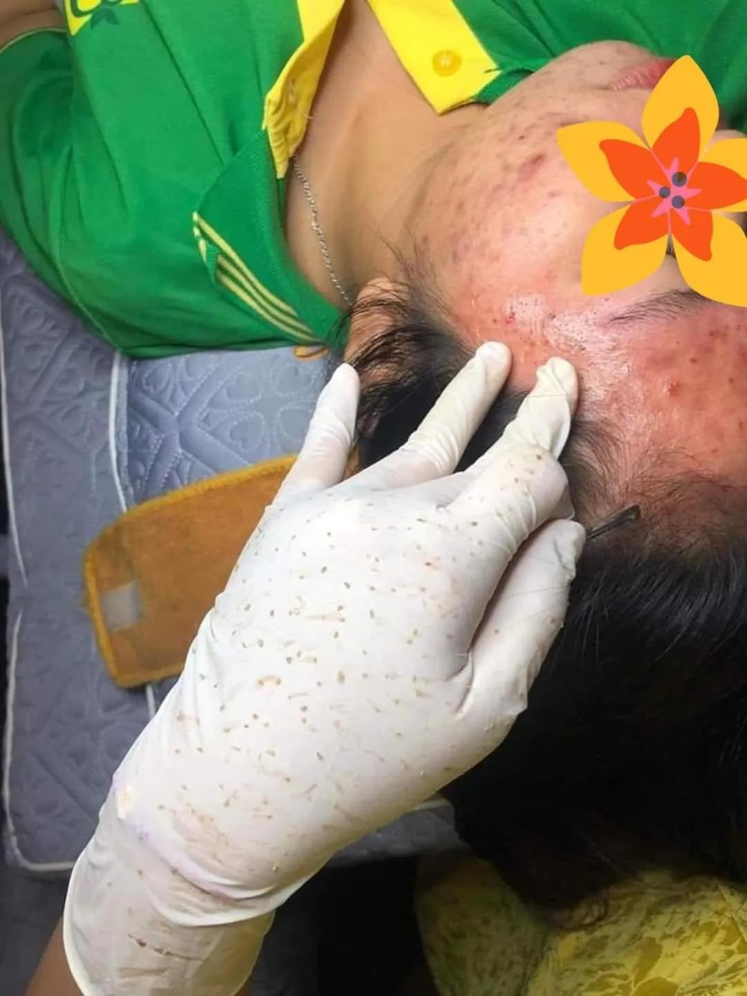 Top 10 địa chỉ spa trị mụn uy tín và hiệu quả nhất tại Ninh Thuận