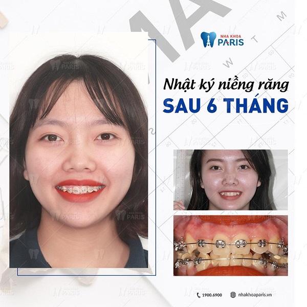 Top 10 địa chỉ niềng răng trả góp chất lượng và uy tín hàng đầu tại Hà Nội