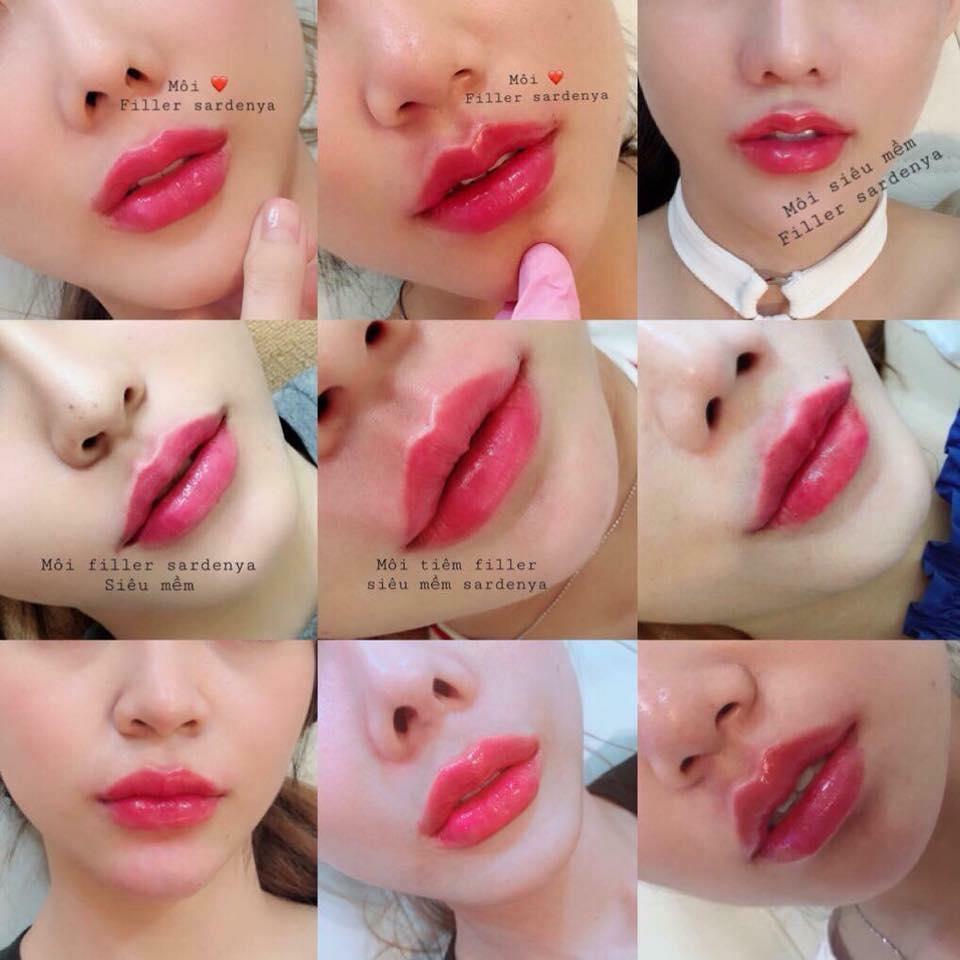 7 Địa điểm tiêm filler - botox đáng tin cậy bậc nhất tại TP. Biên Hòa, Đồng Nai