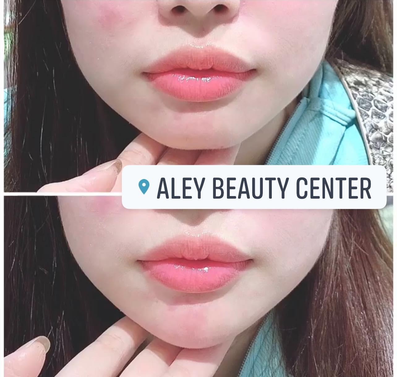 7 Địa Chỉ Tiêm Filler - Botox Đáng Tin Cậy Nhất TP. Thủ Đức, HCM