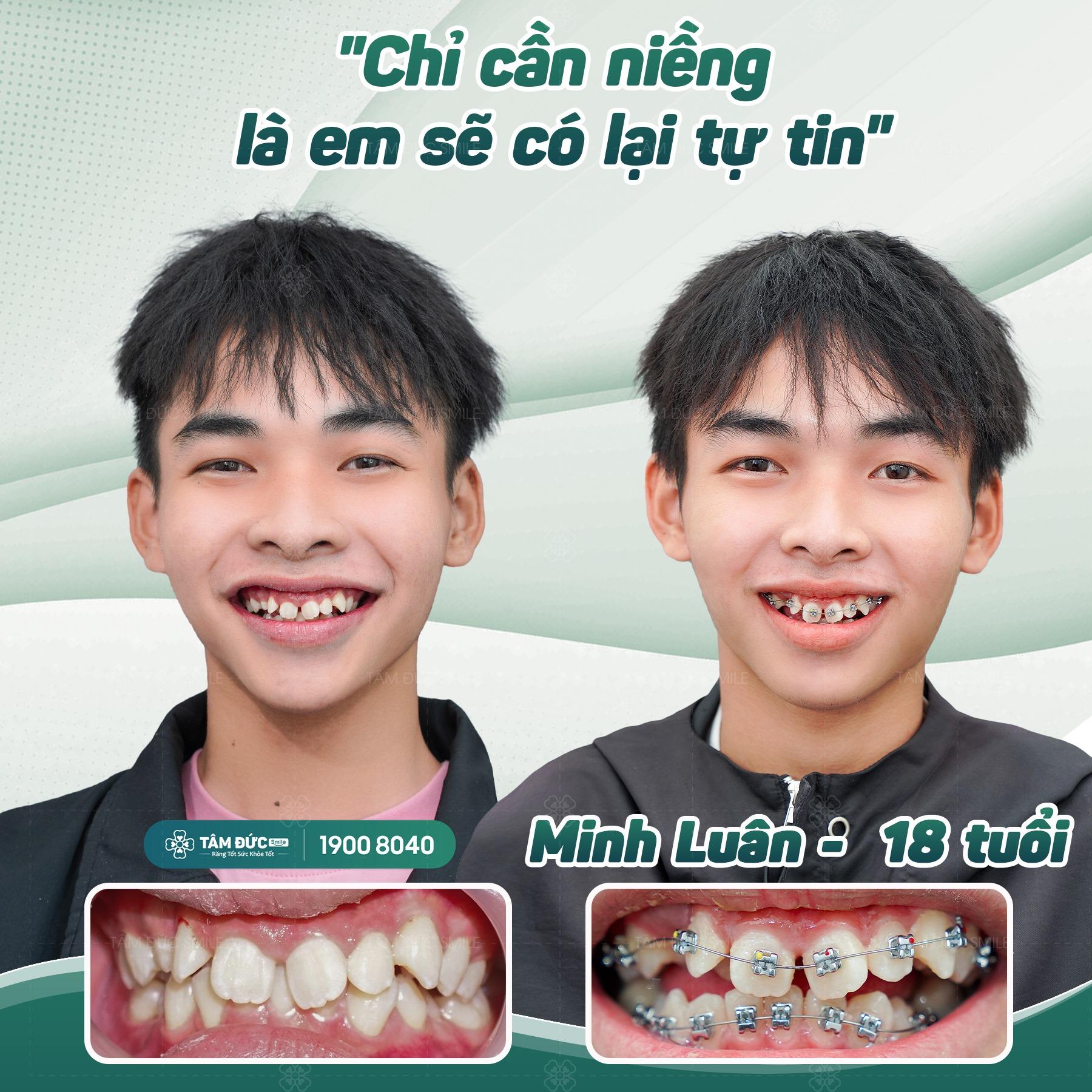 Top 8 địa chỉ niềng răng uy tín tại Vũng Tàu