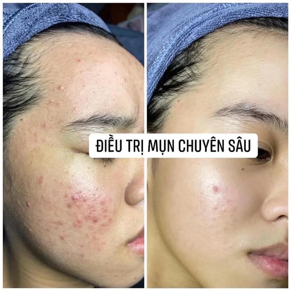 7 Địa chỉ Spa trị mụn uy tín nhất tại Kon Tum bạn nên biết