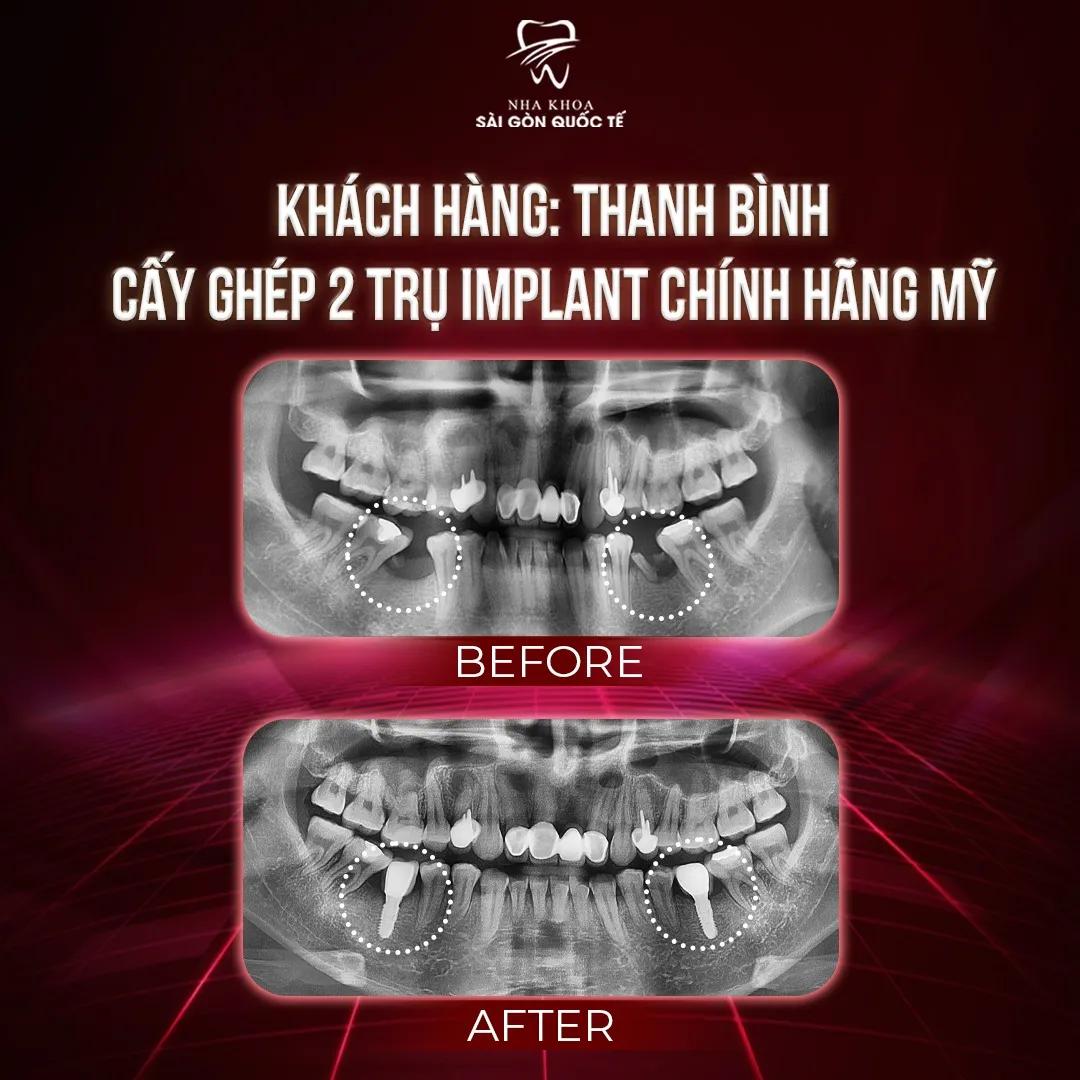 Danh sách 10 phòng khám nha khoa cấy ghép implant chất lượng nhất TP. Buôn Ma Thuột