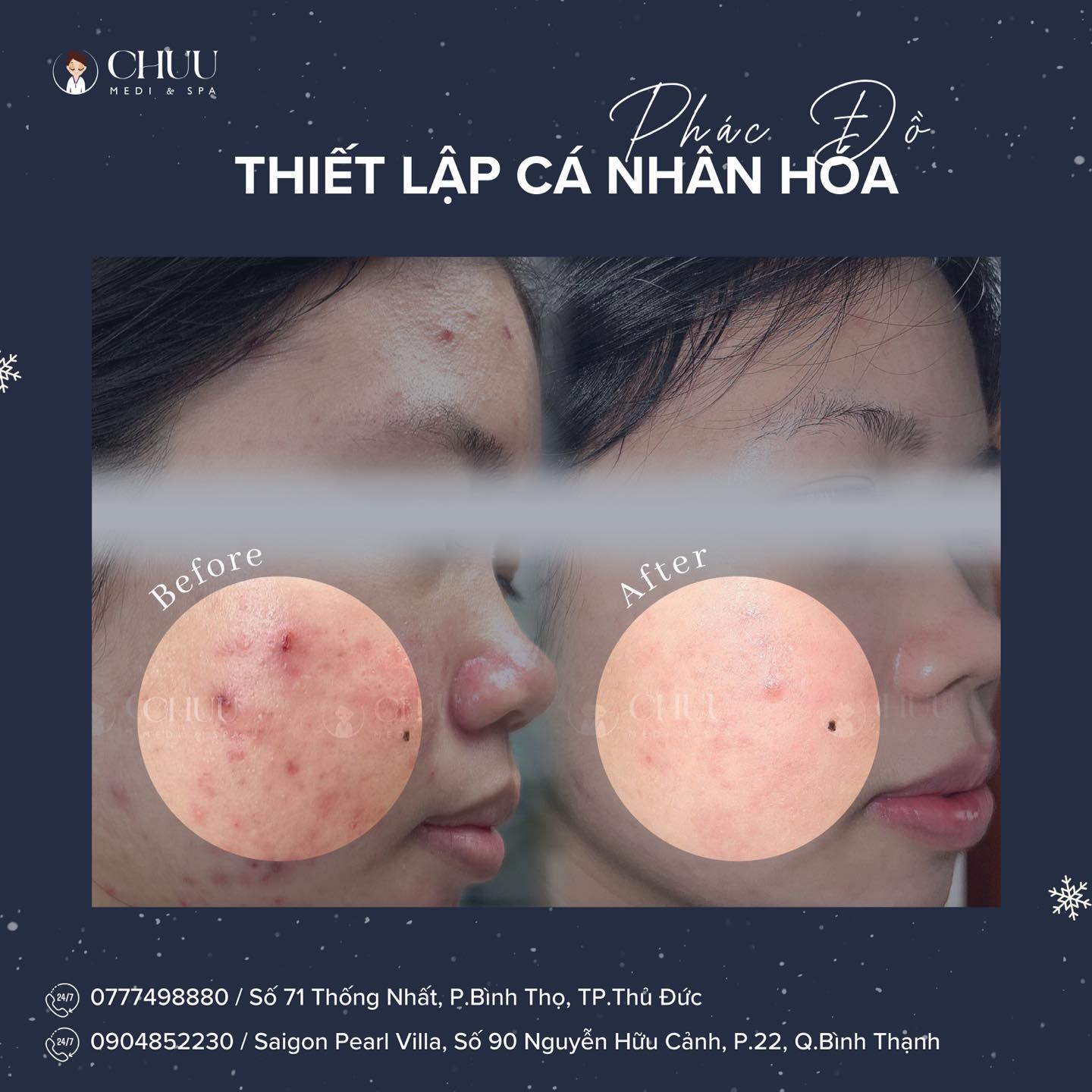 10 Địa chỉ trị mụn uy tín và hiệu quả hàng đầu tại TP. Thủ Đức, TP. HCM