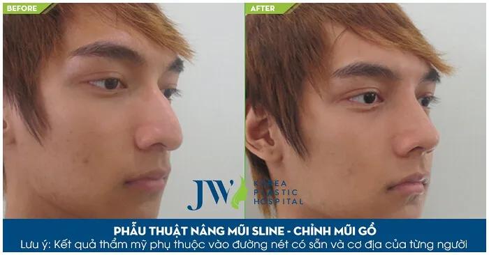 5 địa chỉ nâng mũi nam giới đáng tin cậy nhất TP.HCM