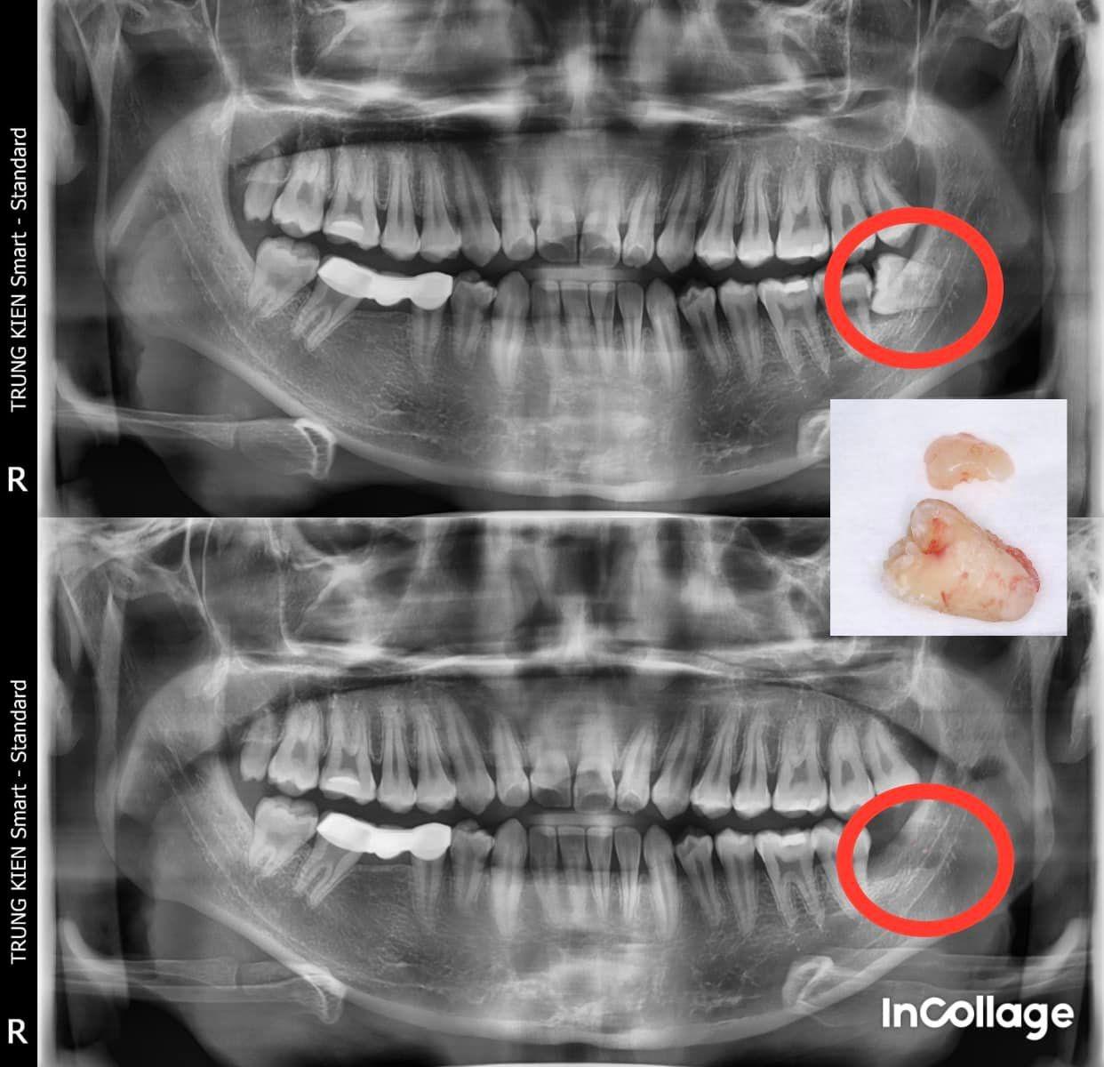 7 Địa chỉ nha khoa uy tín nhổ răng khôn tại Gia Lai được đánh giá cao