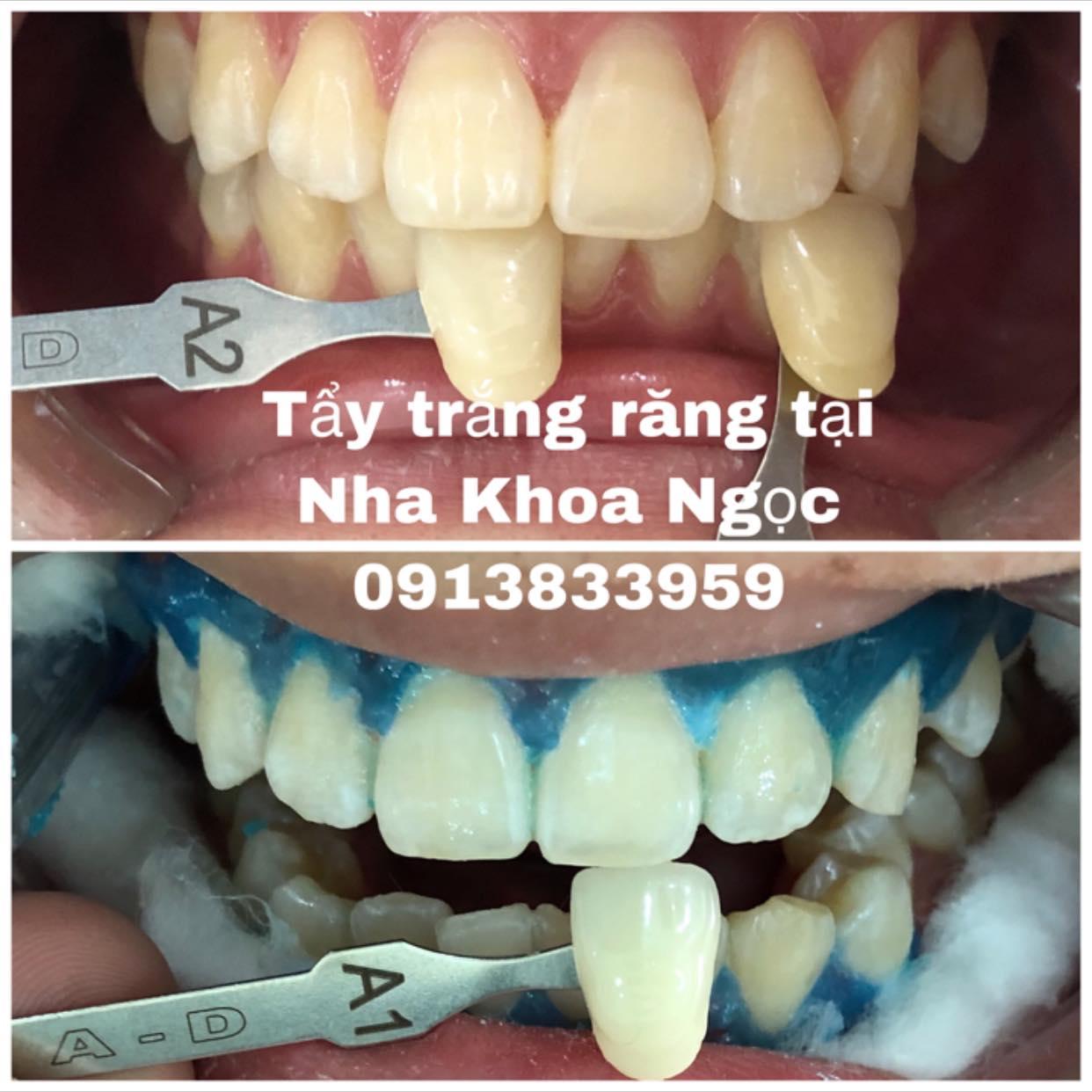 6 Địa chỉ tẩy trắng răng đáng tin cậy nhất tại Thái Bình