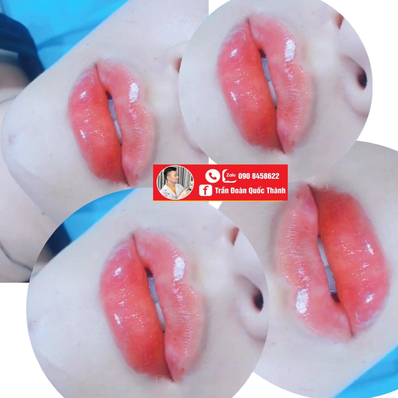 Top 9 Địa Chỉ Tiêm Filler - Botox Uy Tín, Chất Lượng Tại Cần Thơ