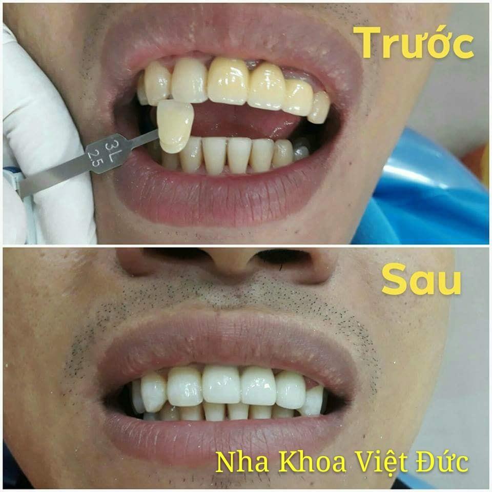 Top 5 địa chỉ tẩy trắng răng chất lượng và đáng tin cậy nhất tại Tuyên Quang