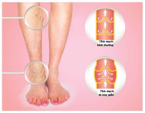 6 địa điểm khám và chữa suy giãn tĩnh mạch uy tín bậc nhất Hà Nội