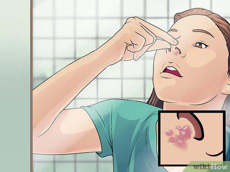 Phương pháp điều trị mụn rộp trong mũi hiệu quả