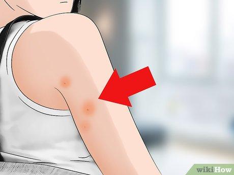 Hướng dẫn nhận biết vết cắn của rệp giường