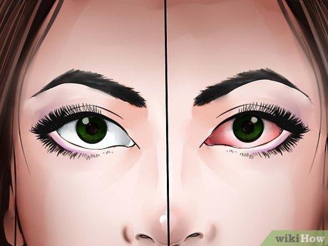 Cách chữa trị nhiễm trùng mắt bằng phương pháp tự nhiên