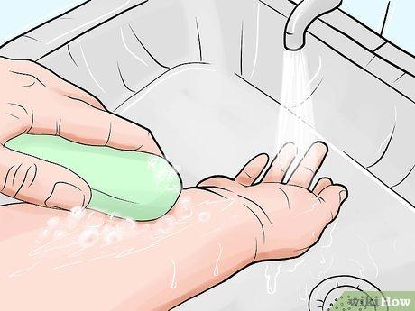Cách Xử lý và Làm Dịu Vết Muỗi Đốt